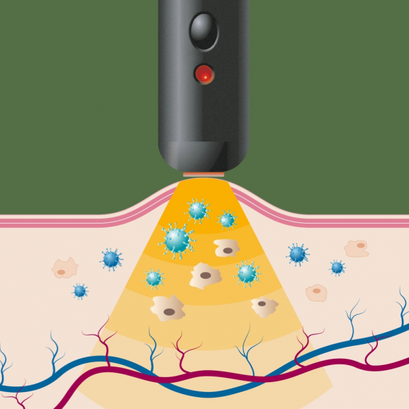 Herpotherm, urządzenie do miejscowego leczenia opryszczki, 1 szt. - zdjęcie produktu