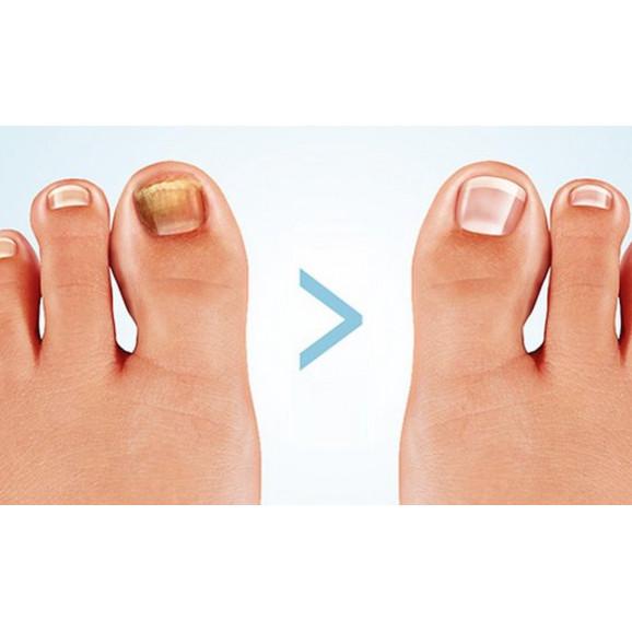 [31.05.2026] Nailner lakier do leczenia grzybicy paznokci 2 w 1, 5 ml – wyrób medyczny - zdjęcie produktu