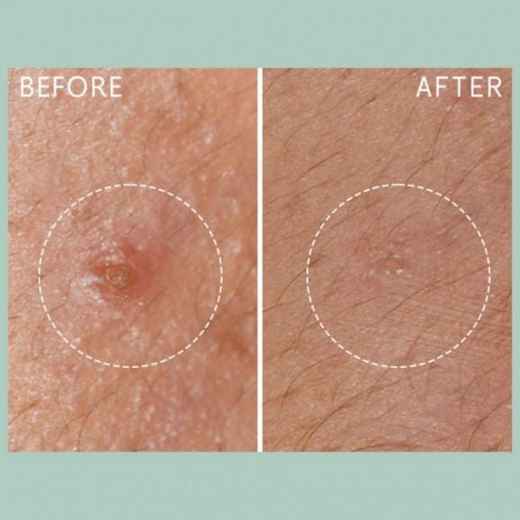 Lierac Protocole Anti-Imperfections Koncentrat stop wypryskom (15 ml) - zdjęcie produktu