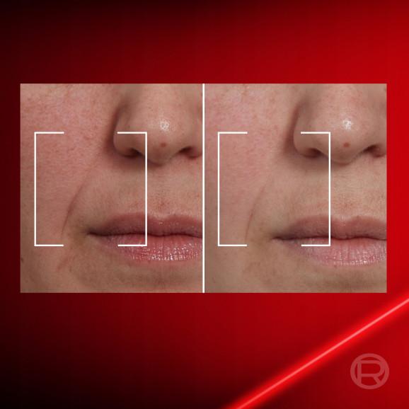 L'Oréal Paris Revitalift Laser Krem Anti-Age głęboka regeneracja na dzień, 50 ml - zdjęcie produktu